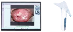 Portable Electronic Colposcope
